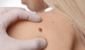 Skin Tag Removal Treatmen