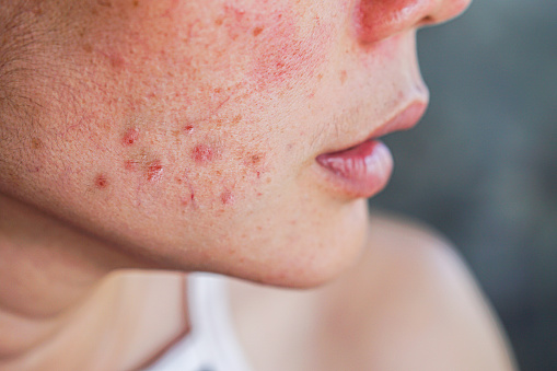 Acne scar specialist, Acne scar specialist in Pune, Acne scar specialist In Kharadi, Acne scar treatment in pune, Acne scar treatment in Kharadi, Acne scar treatment