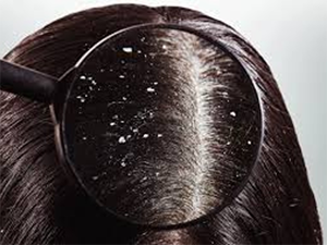 Anti Dandruff specialist, Anti Dandruff specialist in pune, Anti Dandruff specialist in Kharadi, Anti Dandruff treatment in pune, Anti Dandruff treatment in Kharadi, Anti Dandruff treatment